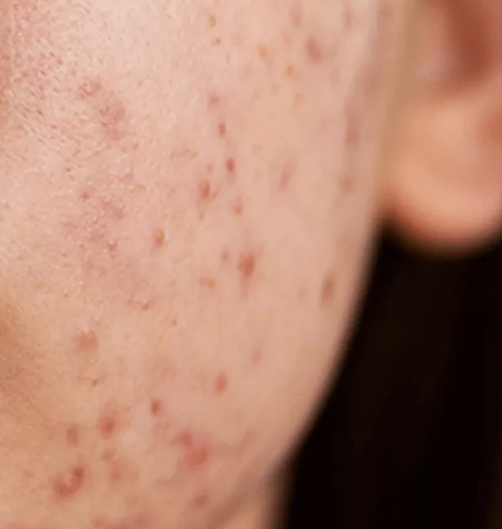 Helps reduce stubborn pimples quickly